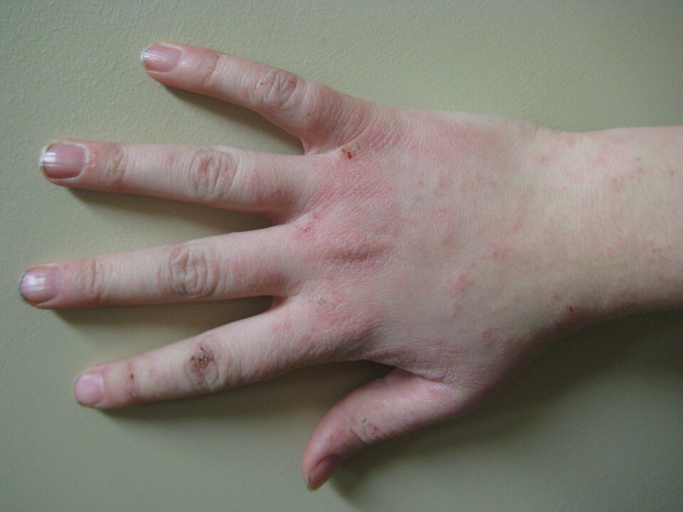 Clinical photograph of a hand with dermatitis, showing visible redness and scaling.